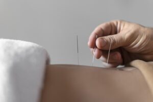 Acupuncture needles being placed during treatment session in Suffolk