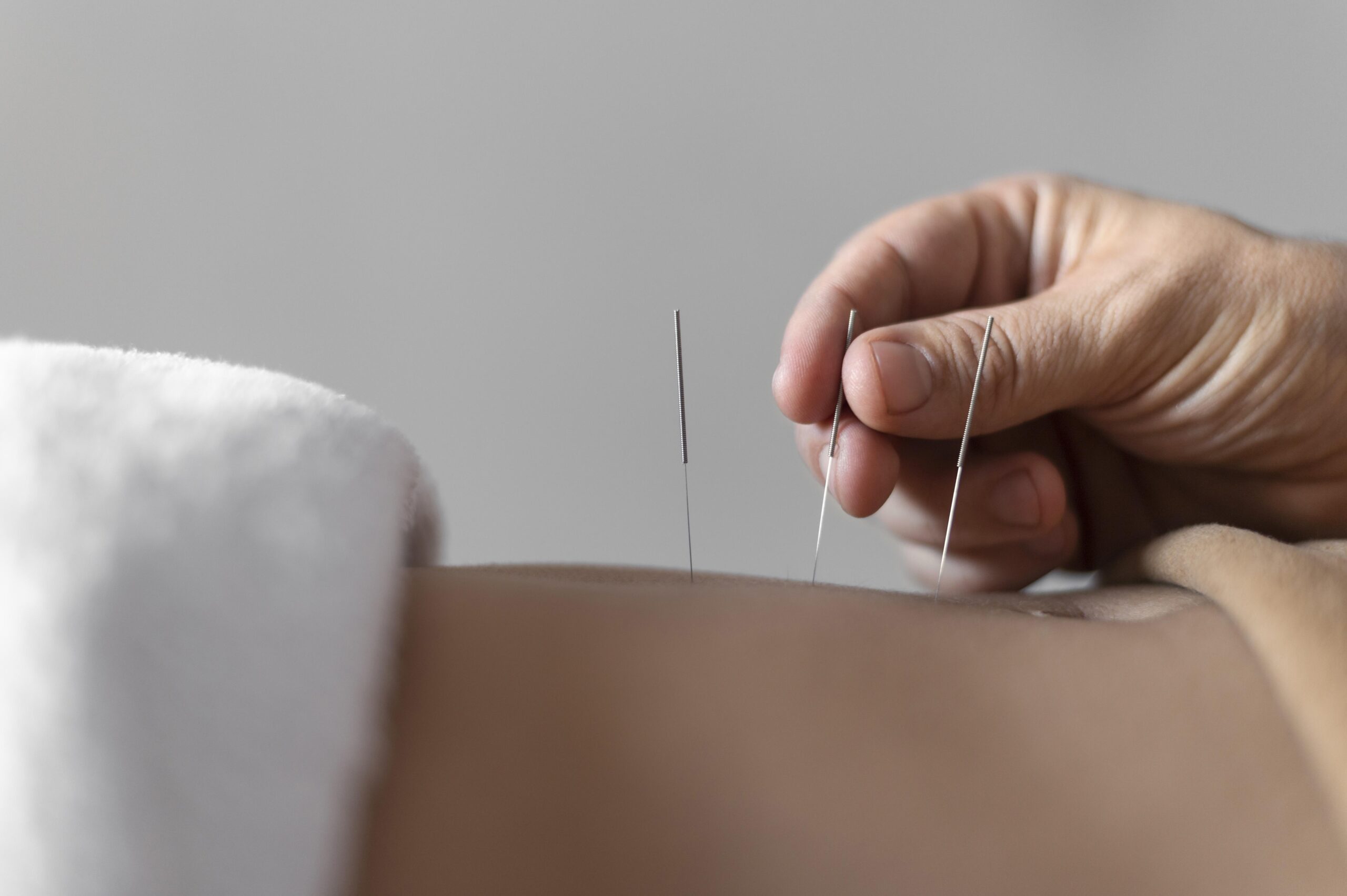 Acupuncture needles being placed during treatment session in Suffolk